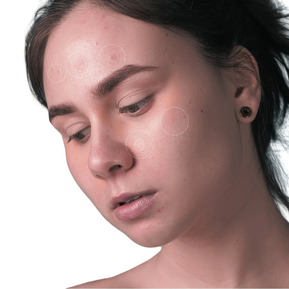 36pcs Hydrocolloid Acne Patches - Absorb Pus & Oil, Reduce Redness, Invisible Fit for All-Day Wear. Quake