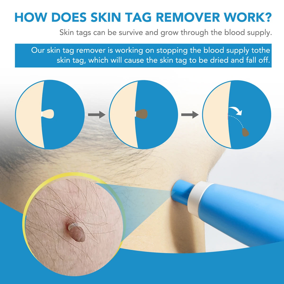 2 In1 Painless Auto Skin Tag Mole Wart Removal Kit Cleaning Tools Quake