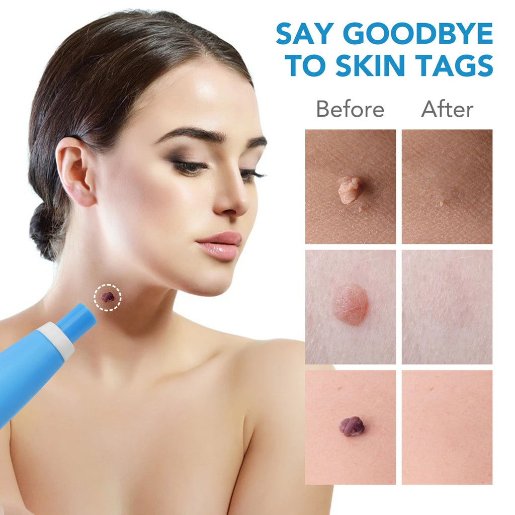 2 In1 Painless Auto Skin Tag Mole Wart Removal Kit Cleaning Tools Quake