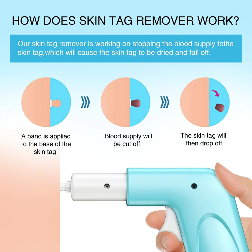 3 In 1 Auto Skin Tag Removal Kit Painless Mole Wart Remover Equipment Micro Skin Tag Treatment Tool Easy To Clean Skin Care Tool Quake