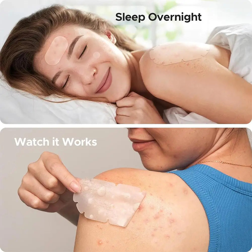 Large Pimple Patches Bulk for Face, 5 Sizes Hydrocolloid Acne Patches for Covering Body, Forehead, Chin Blemishes Zit Breakouts Quake